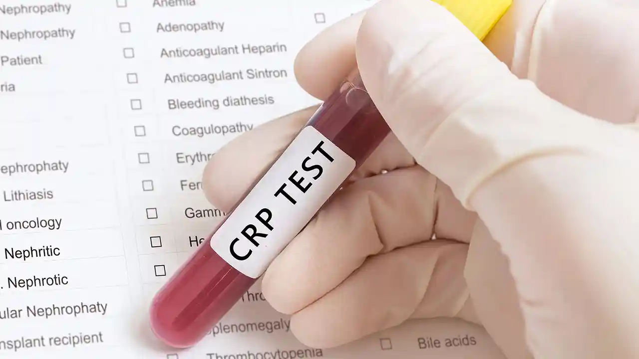 crp test crp nedir what is crp CRP Nedir, CRP Testi Nedir, CRP Değerleri, CRP Nasıl ve Neden Yaptırılır?