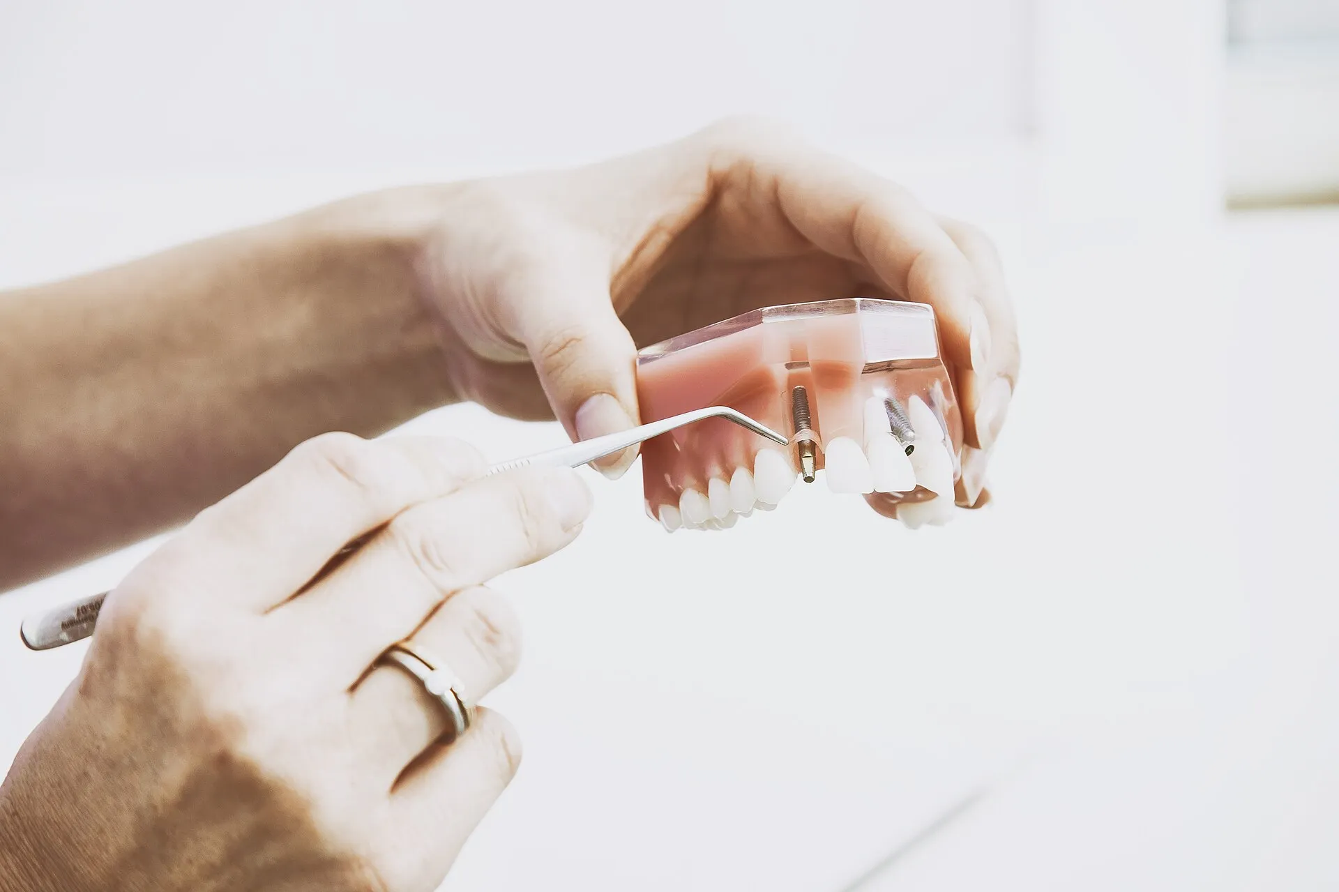 Diş implantı bileşenlerini gösteren yakın çekim fotoğraf